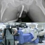 Kyste synovial du poignet : causes, symptômes, douleur, traitements